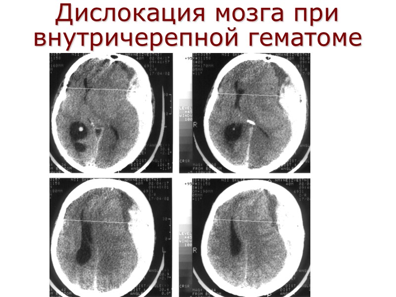 Дислокация мозга при внутричерепной гематоме